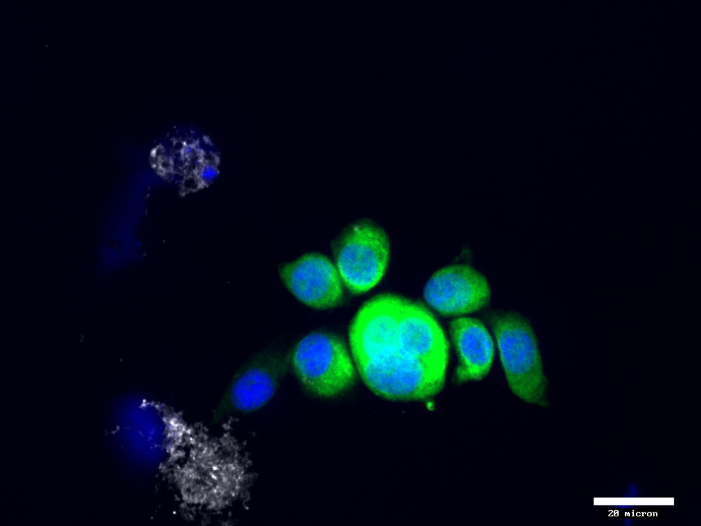 Cluster of CK + CTCs (green) from breast cancer patient (20x)